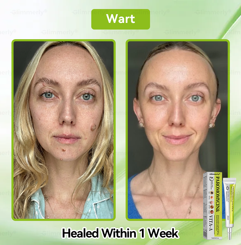 Zeitlich begrenztes Angebot 🎁 Herzlichen Glückwunsch! Du bist heute der 269. Kunde 🎉 Jetzt 50% Rabatt auf deinen nächsten Einkauf von 𝐺𝑙𝑖𝑚𝑚𝑒𝑟𝑙𝑦® Paromomycin & Vita-A Retinol Skin Repair Cream 🛒