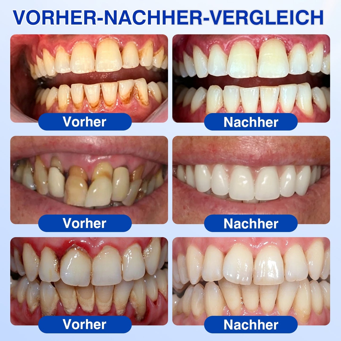 🇩🇪Glimmerly®🦷 GumRevive Parodontales Reparaturgel✨