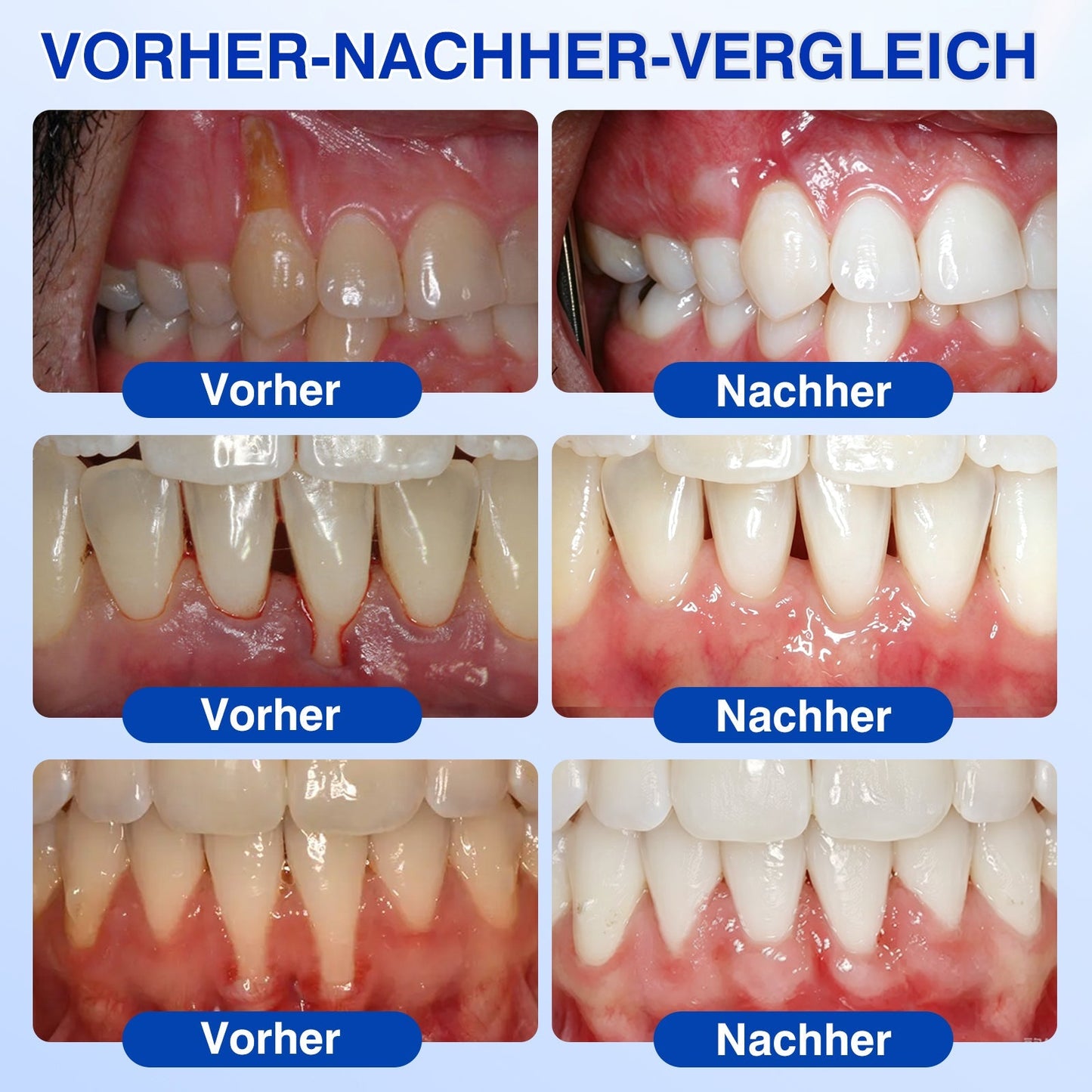 🇩🇪Glimmerly®🦷 GumRevive Parodontales Reparaturgel✨