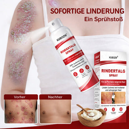 KUBOZN® Rindertalg-Spray für juckende, schuppige Psoriasis-Haut 1