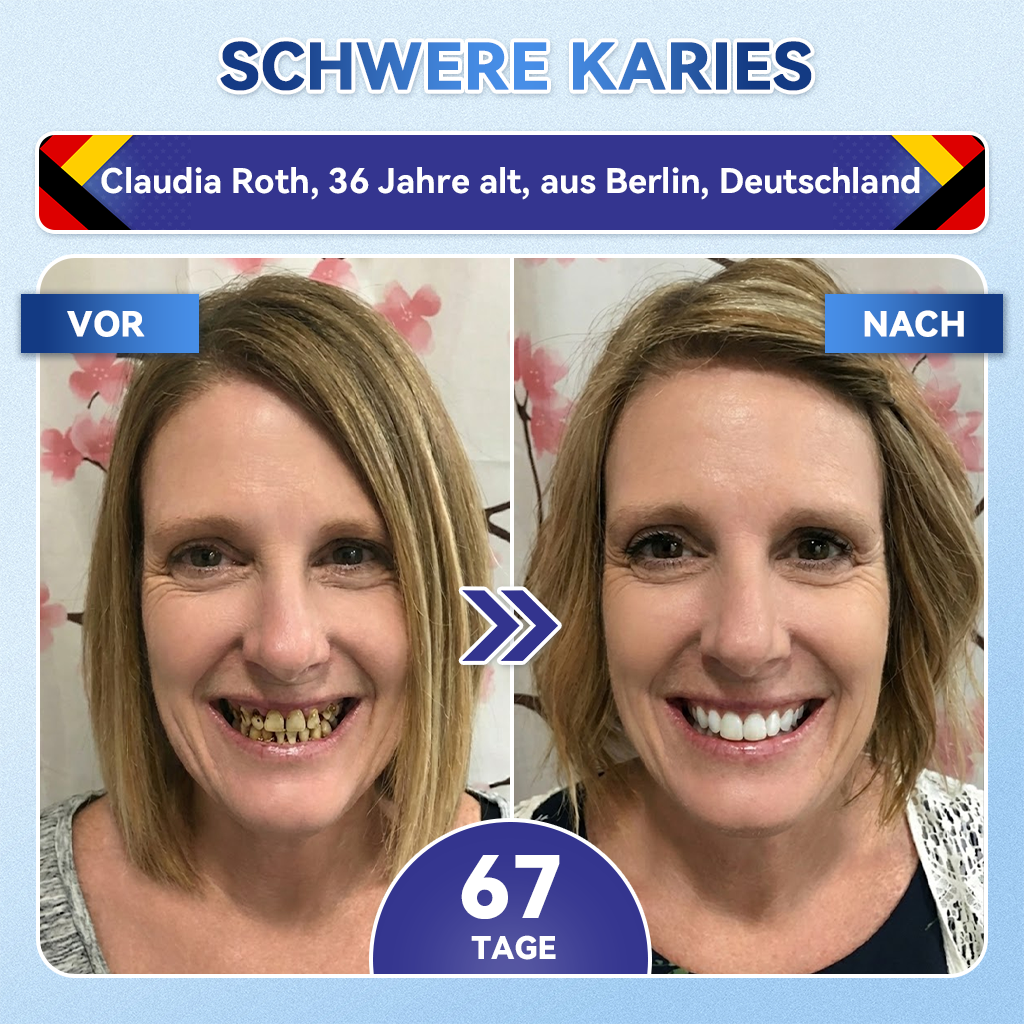𝐺𝑙𝑖𝑚𝑚𝑒𝑟𝑙𝑦®🏆 Tideglusib Zahn & Zahnfleisch Schnelllösliche Repair-Mundstreifen🎋