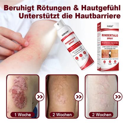 KUBOZN® Rindertalg-Spray für juckende, schuppige Psoriasis-Haut 1